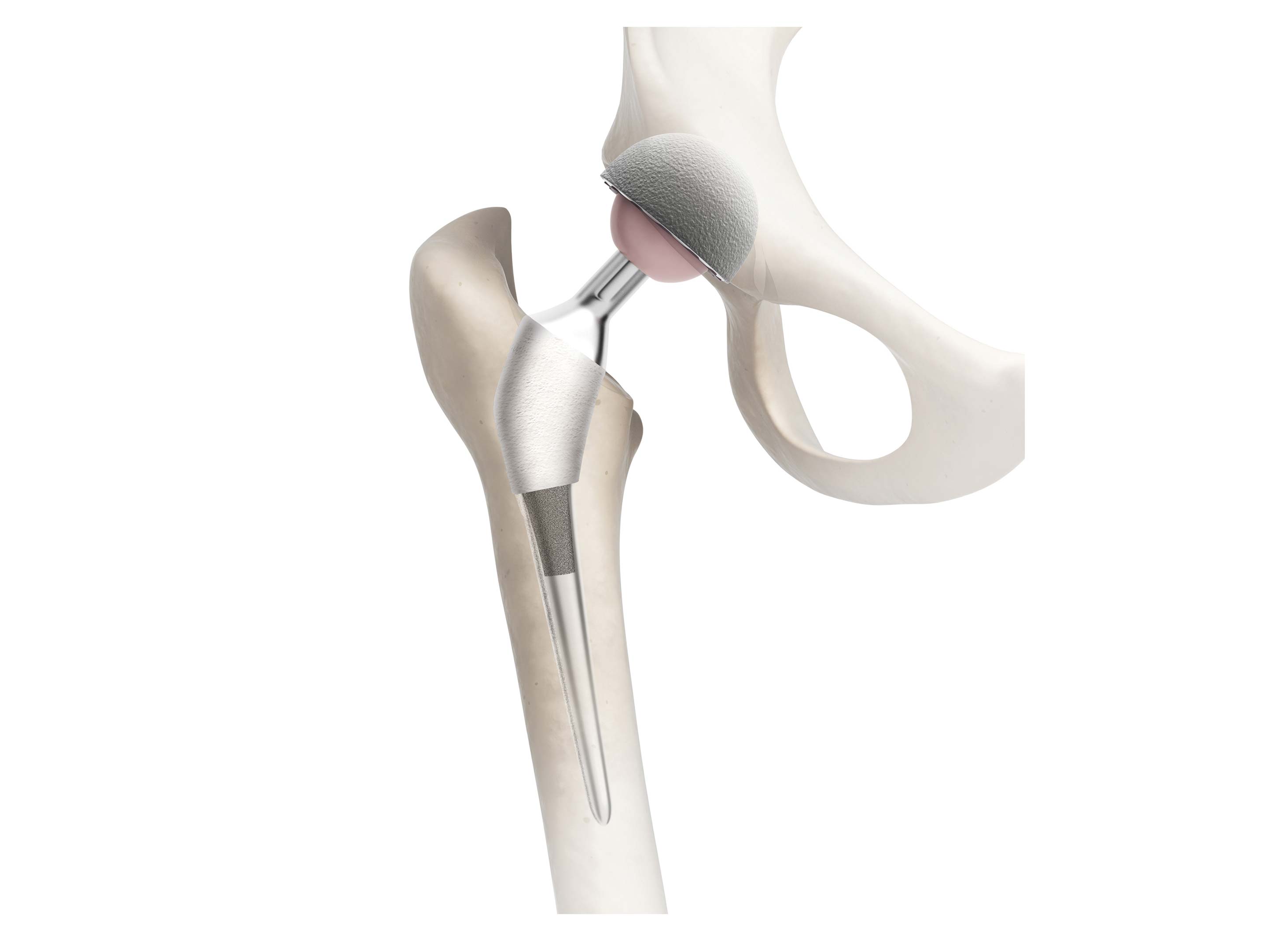 Orthopaedic Implant