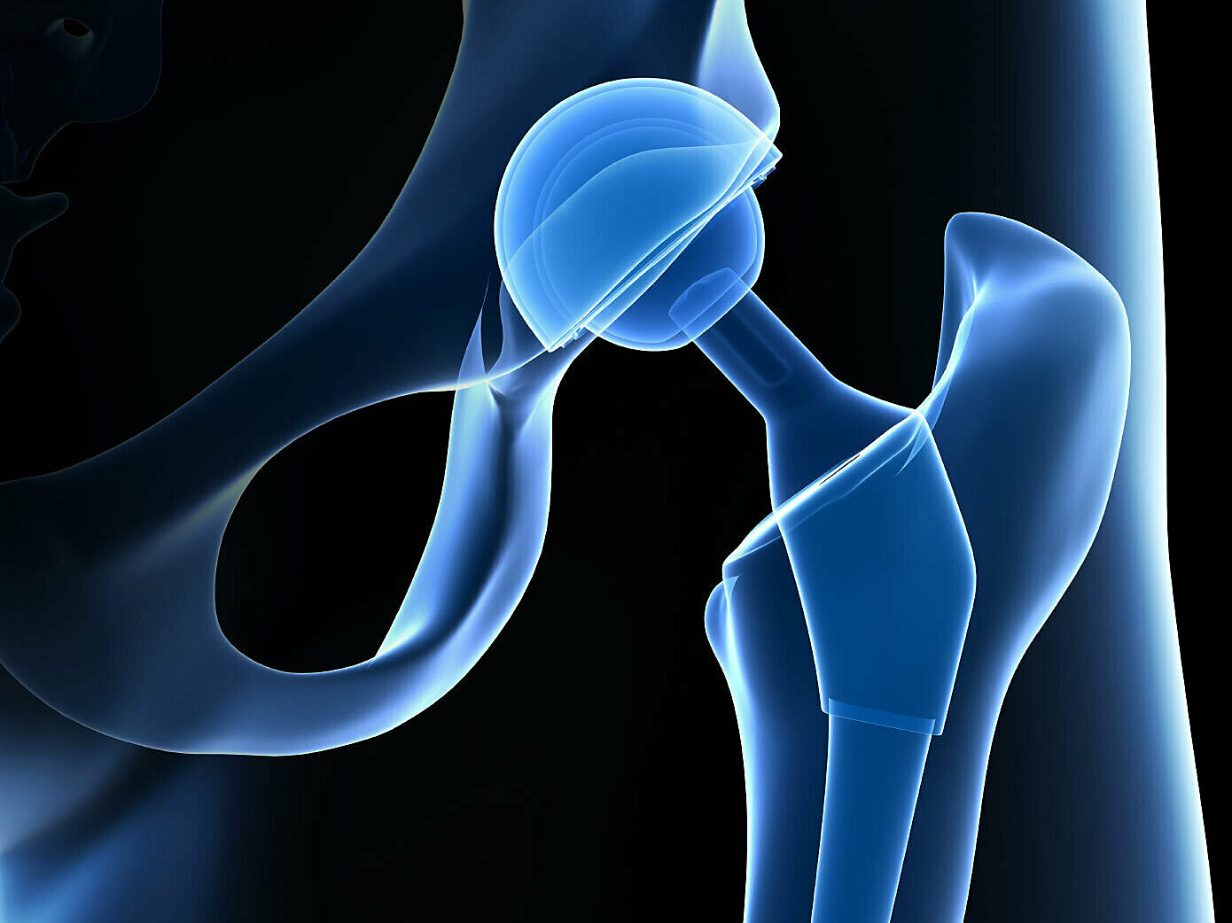 Hip Joint Replacement